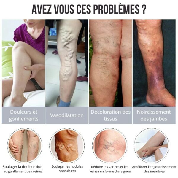 VariStop: Dites Adieu aux Varices VariStop: Dites Adieu aux Varices