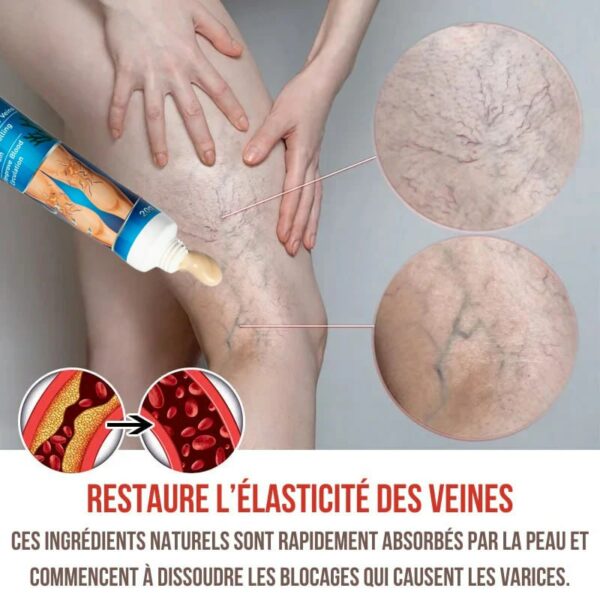 VariStop: Dites Adieu aux Varices VariStop: Dites Adieu aux Varices